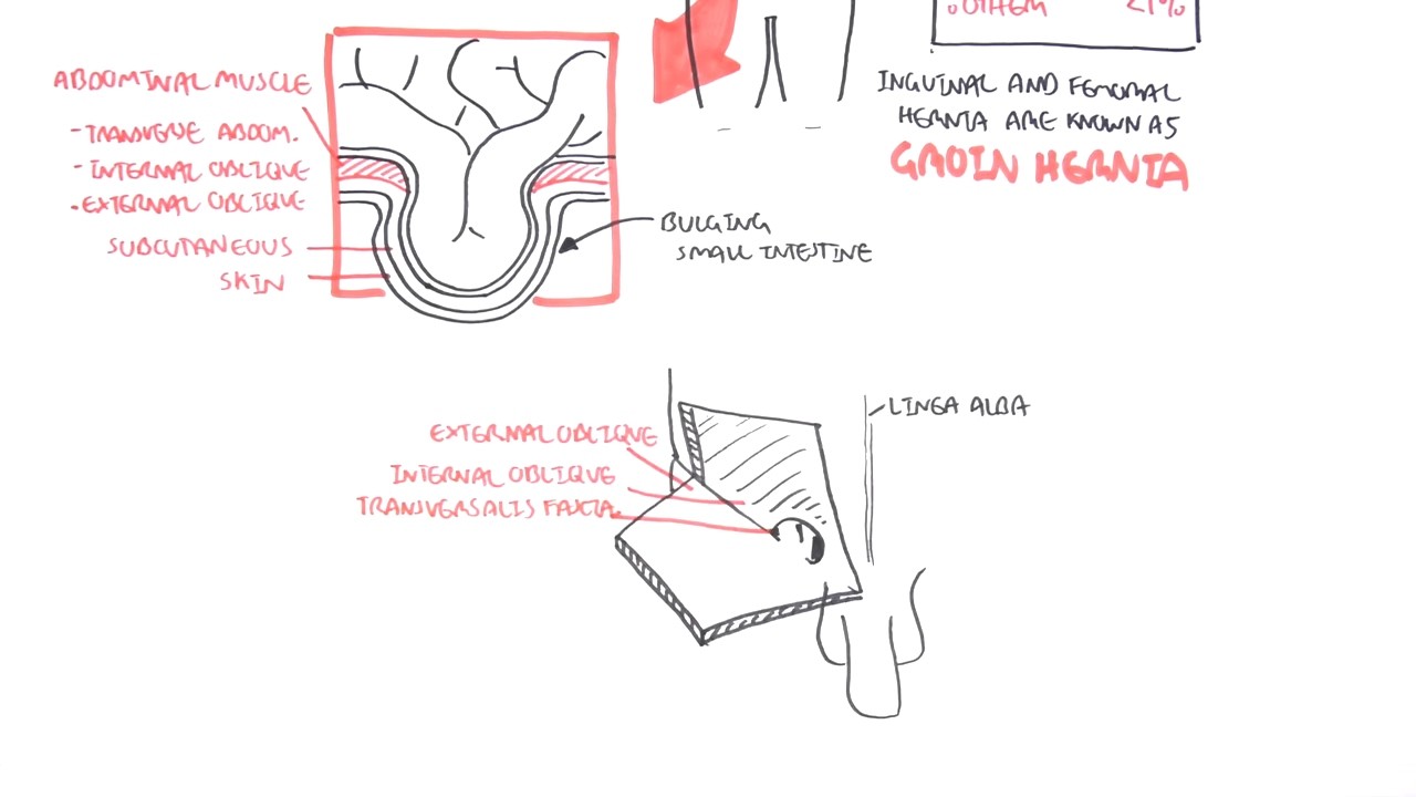 Introduction to Direct and Indirect Inguinal Hernia
