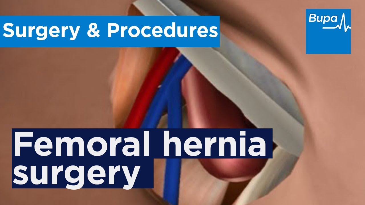 How open femoral hernia surgery is carried out