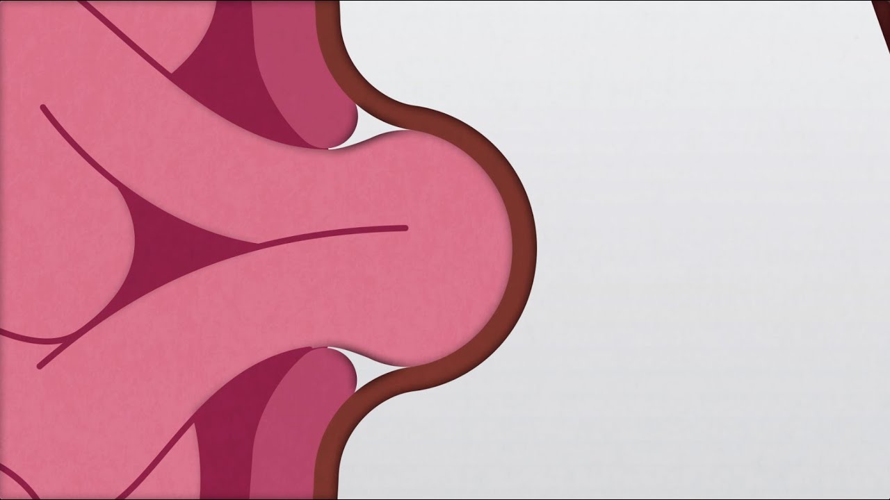 What Is a Hernia and How Is One Repaired?