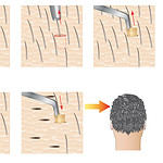 how much does it cost for hair transplant