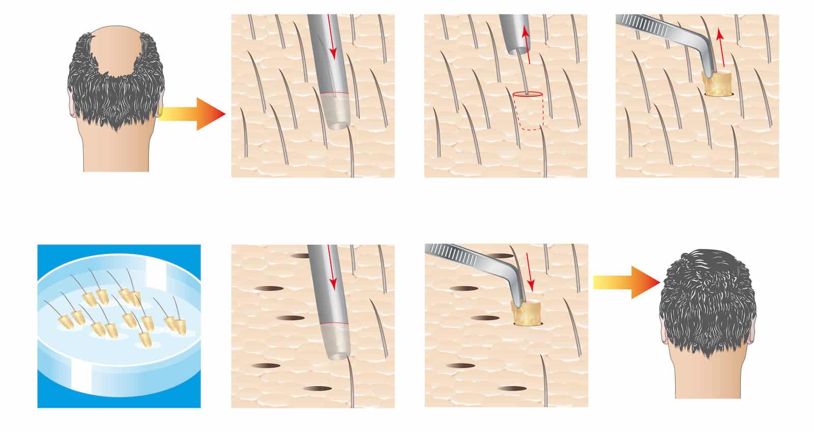 how much does it cost for hair transplant