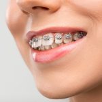 Average cost of dental braces in Australia.