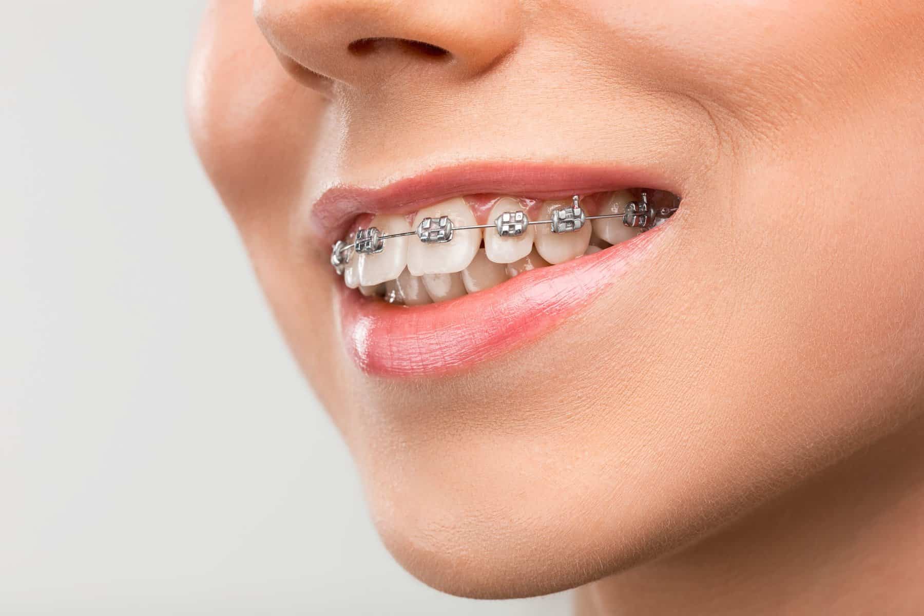 Average cost of dental braces in Australia.
